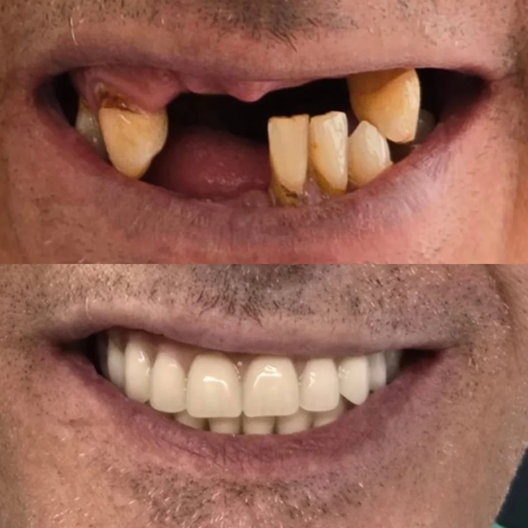 Antes e depois — Reabilitação total com implante e prótese fixa