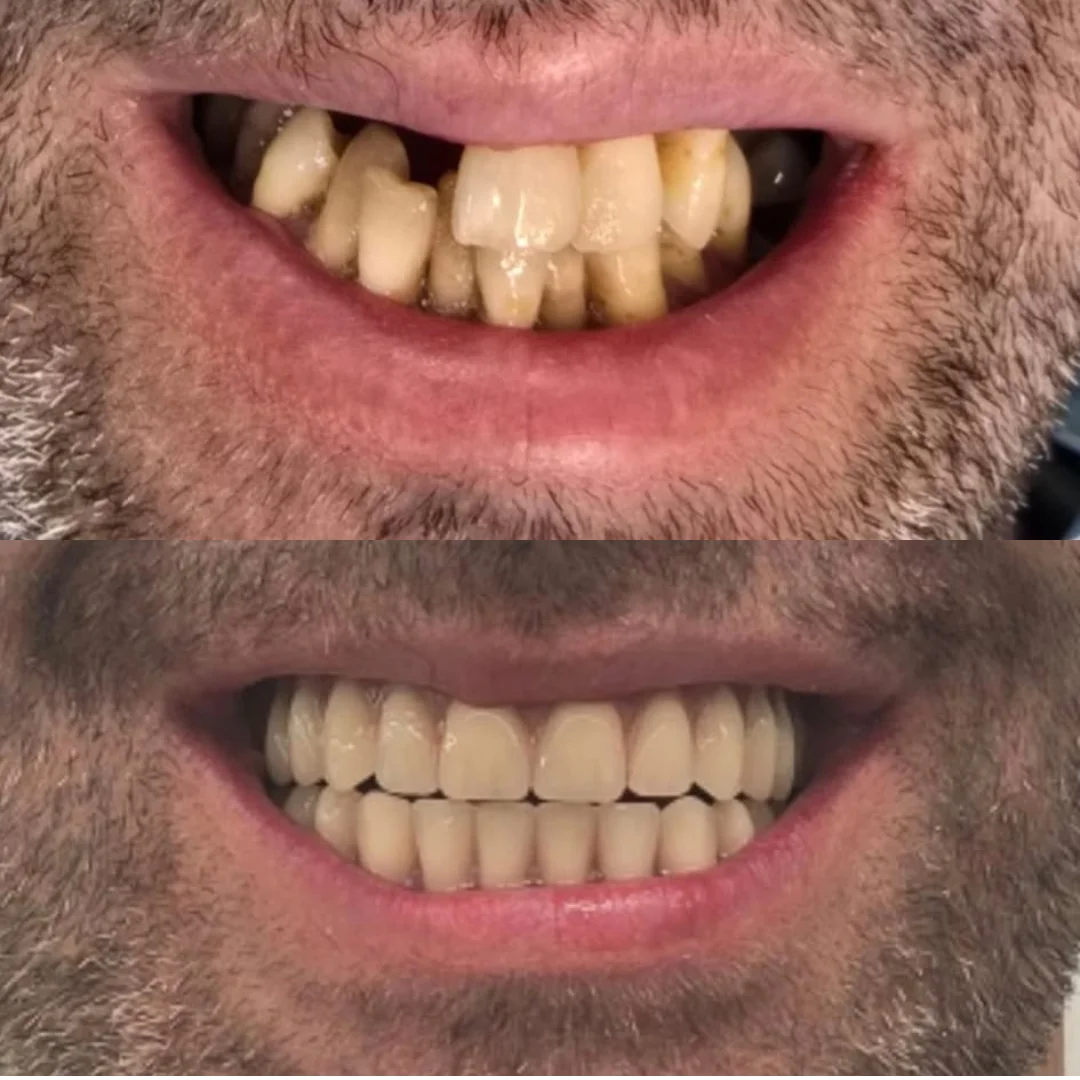 Antes e depois — Reabilitação total com implante e prótese fixa