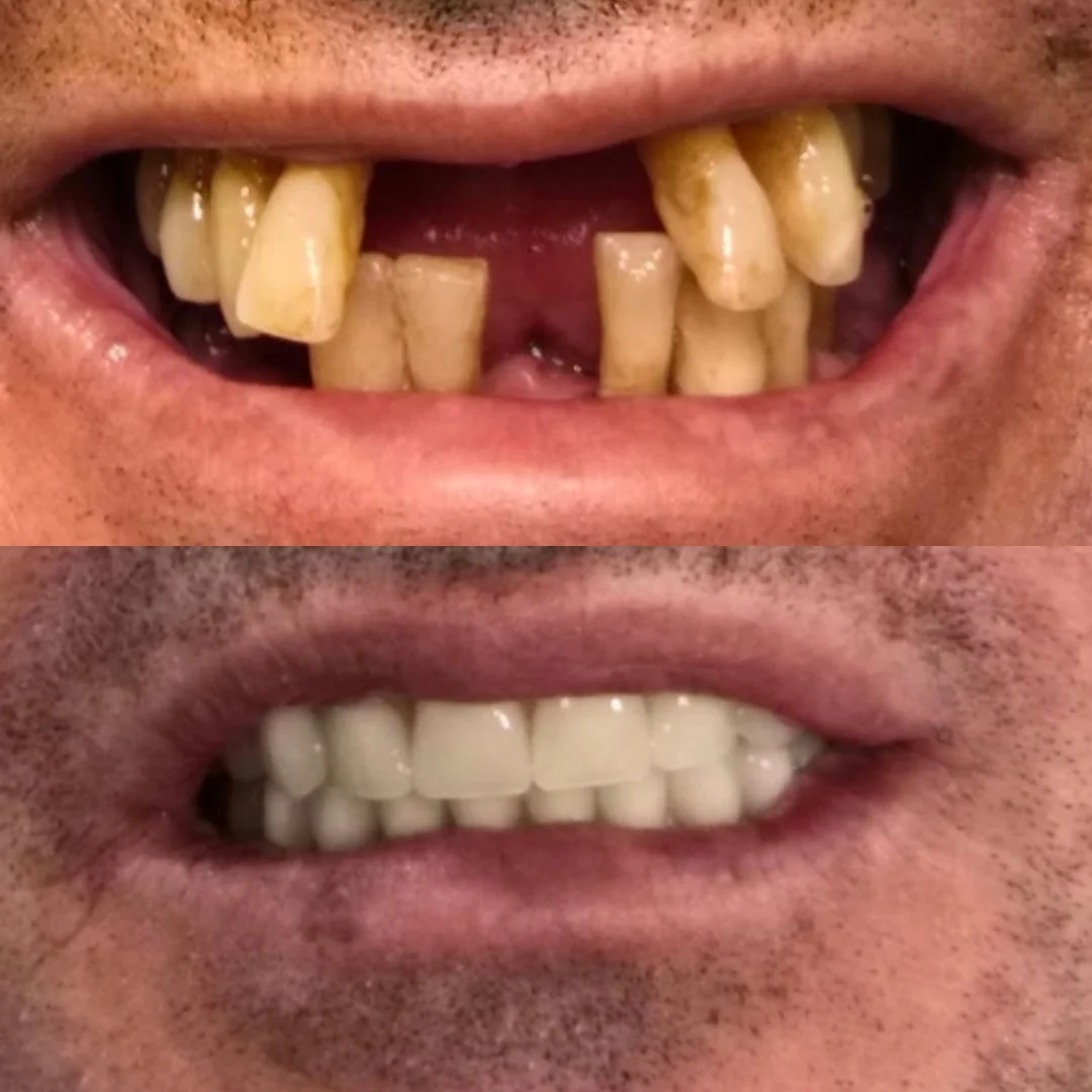 Antes e depois — Reabilitação total com implante e prótese fixa