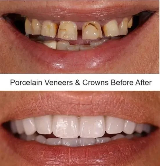 Antes e depois — Facetas e coroas