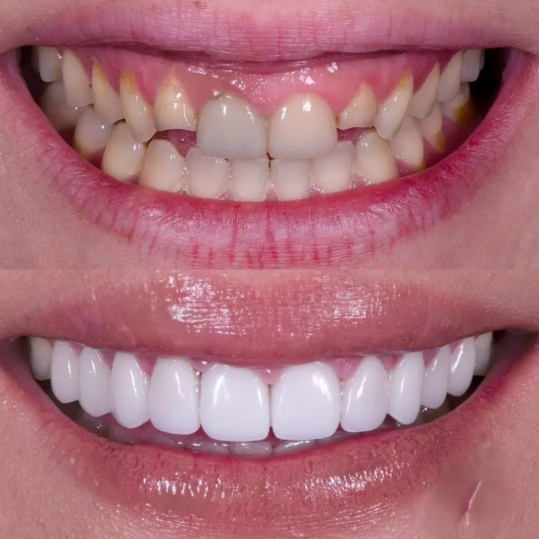 Facetas de porcelana — antes e depois