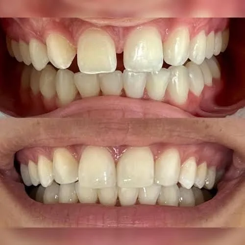 Antes e depois — Facetas cerâmicas