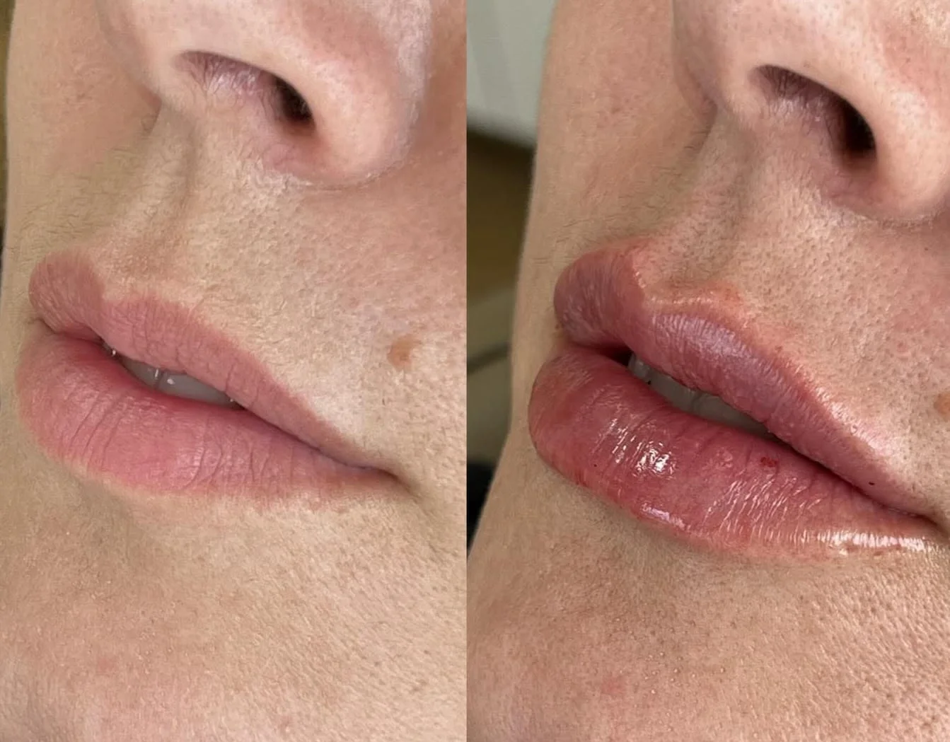 Harmonização facial — antes e depois