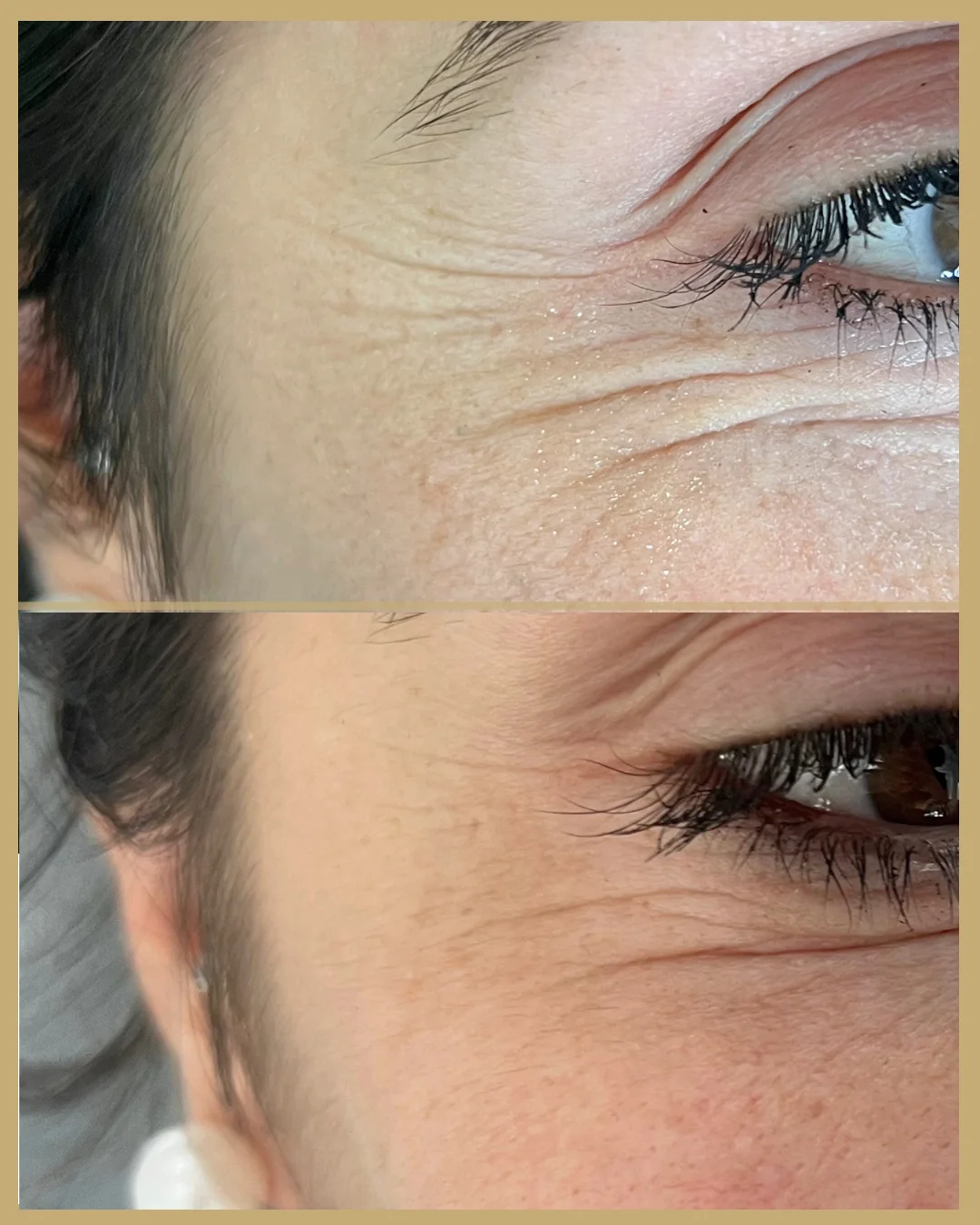 Antes e depois — Harmonização facial olhos