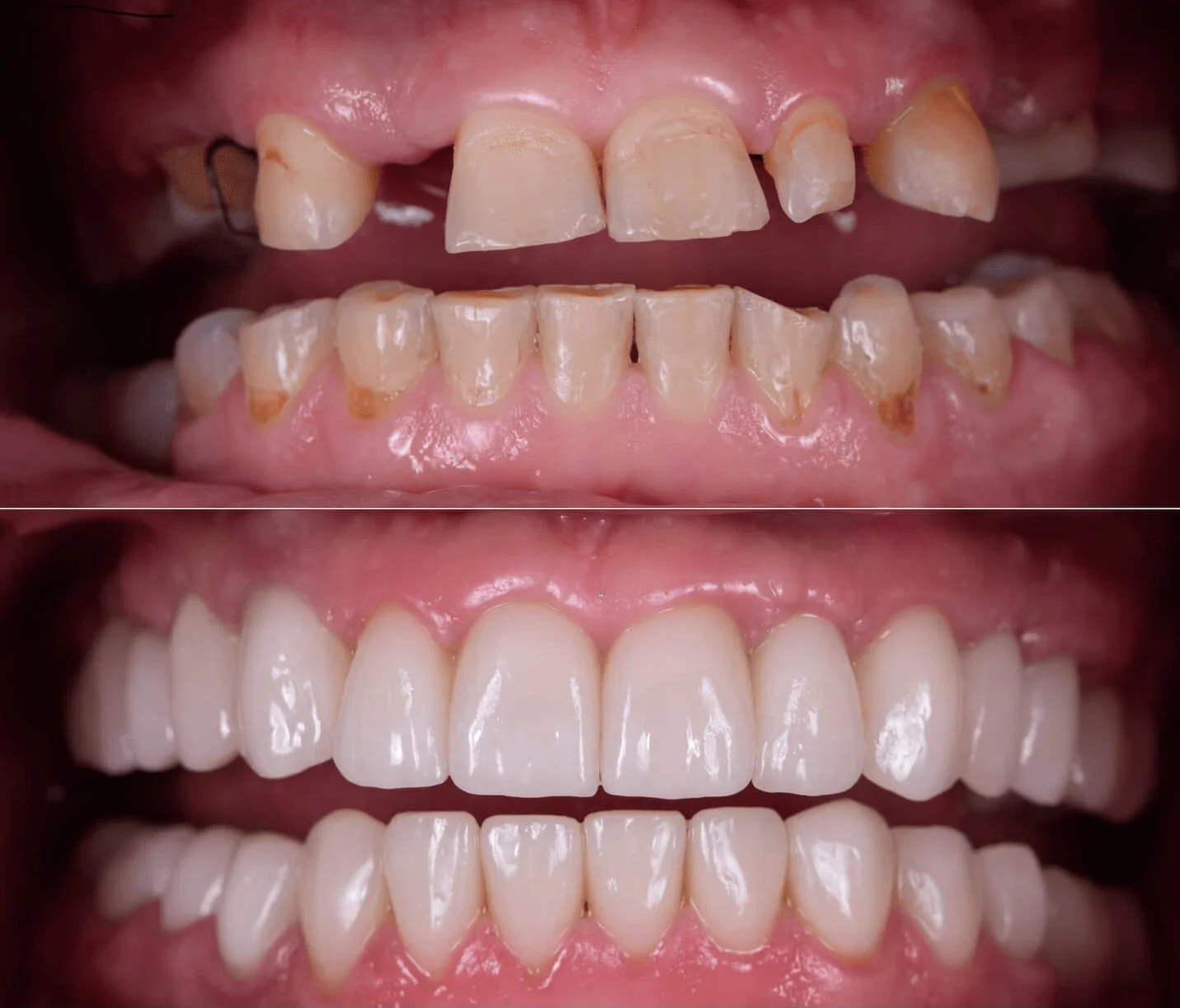 Implante dentário — antes e depois